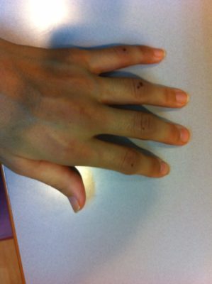 炎症で腫れた指（実際画像）